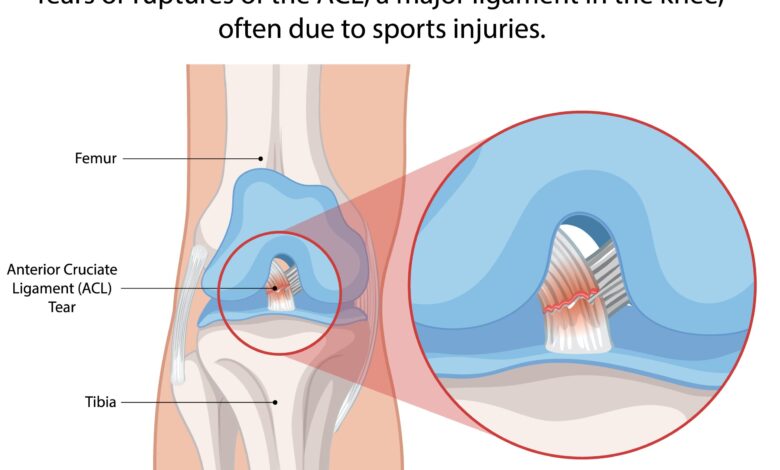 Understanding Anterior Cruciate Ligament (ACL) Injuries - A ...